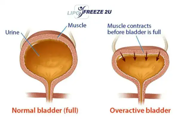 diagram of overactive bladder treatment Amersham