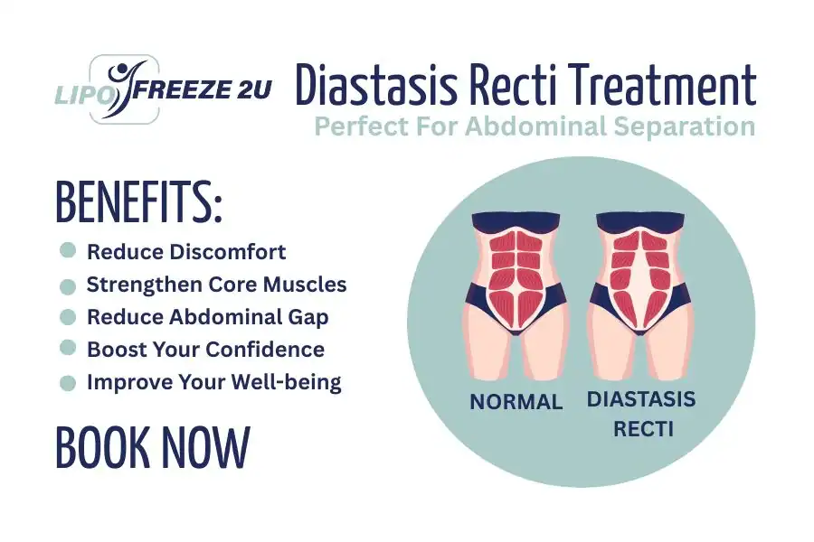How Long Will It Take to See Improvements in Diastasis Recti Amersham
