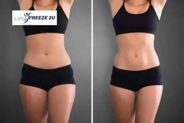 How Can LIPO FREEZE 2U Support Your Post-Pregnancy Body Recovery Amersham?