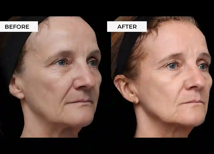 How Many RF Microneedling Sessions Will You Need to See a Difference Amersham?