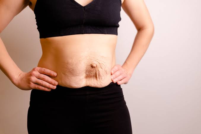 Is Surgery Really the Only Way to Repair Diastasis Recti Amersham?