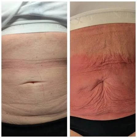 How Does RF Microneedling Improve Crepey, Thin and Uneven Skin Texture Amersham?