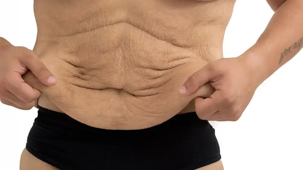 Why Does Weight Loss Medication Leave Some People With Loose or Sagging Skin Amersham?
